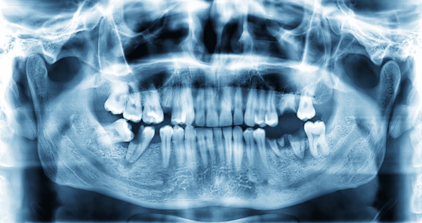 The Danger of Living with Missing Teeth